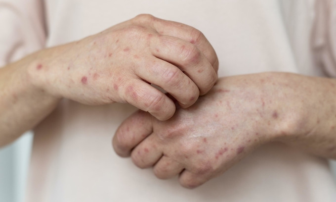 Bệnh viện Da liễu Trung ương điều trị cho 1 bệnh nhân nam nhiễm HIV và giang mai do quan hệ tình dục không an toàn
