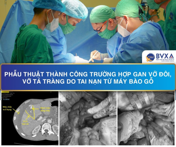 Bệnh viện Đa khoa Xuyên Á Tây Ninh cấp cứu thành công bệnh nhân bị vỡ gan, thủng ruột, sốc mất máu nguy kịch