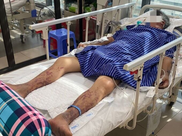Bệnh viện Đa khoa tỉnh Lạng Sơn tiếp nhận 1 bệnh nhân bị nhiễm khuẩn liên cầu lợn do ăn tiết canh