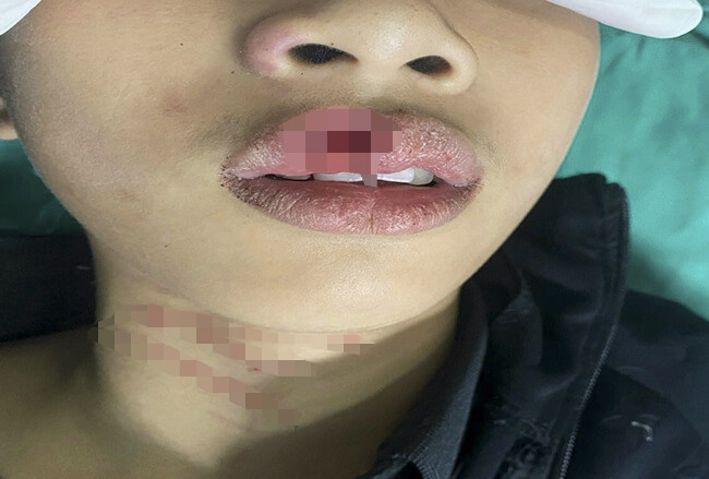 Bệnh viện Nhi Trung ương tiếp nhận điều trị cho hàng trăm bệnh nhi có vết thương phần mềm vùng hàm mặt