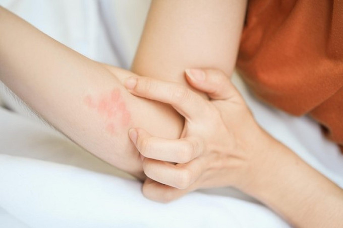 Tình trạng da thường gặp cần chú ý ở người bị bệnh tiểu đường