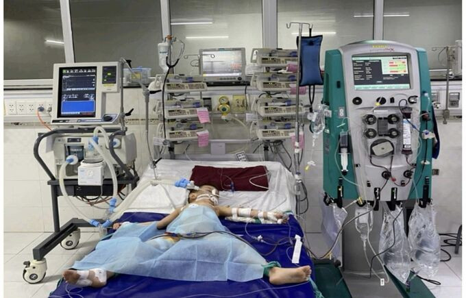 Bệnh viện Nhi Đồng Cần Thơ cứu sống bệnh nhi 42 tháng tuổi bị tay chân miệng độ 4 nguy kịch