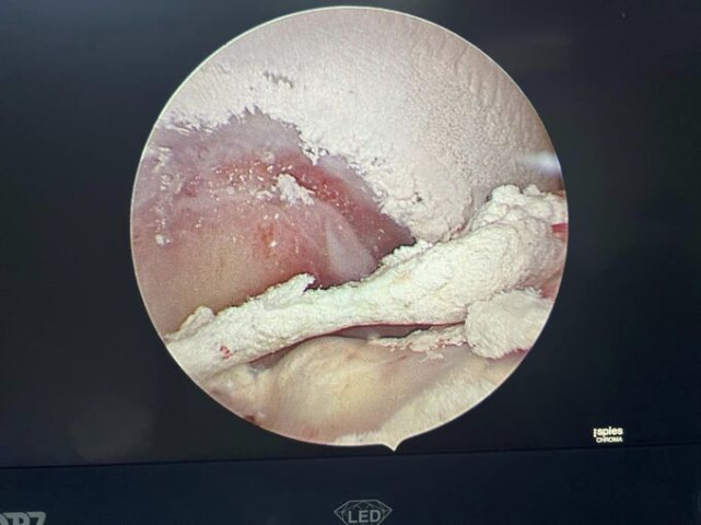 Bệnh viện A Thái Nguyên phẫu thuật khôi phục vận động cho nam bệnh nhân bị gout nặng
