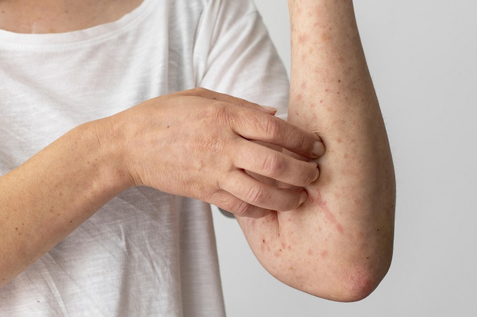 Bến Tre ghi nhận ca dương tính đầu tiên với virus đậu mùa khỉ