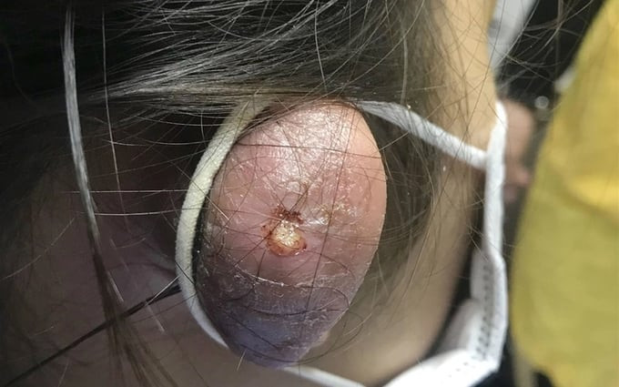 Cảnh báo tình trạng bấm nhiều lỗ tai đeo khuyên gây hoại tử hoặc viêm sụn vành tai nghiêm trọng