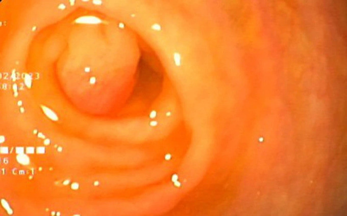 Hải Phòng: Nội soi đại tràng, cắt gọn polyp kích thước 0,5 cm tại lỗ gốc ruột thừa cho bệnh nhi 14 tuổi