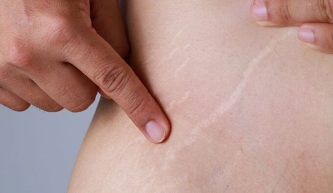 Rạn da và dấu hiệu nhận biết ung thư da