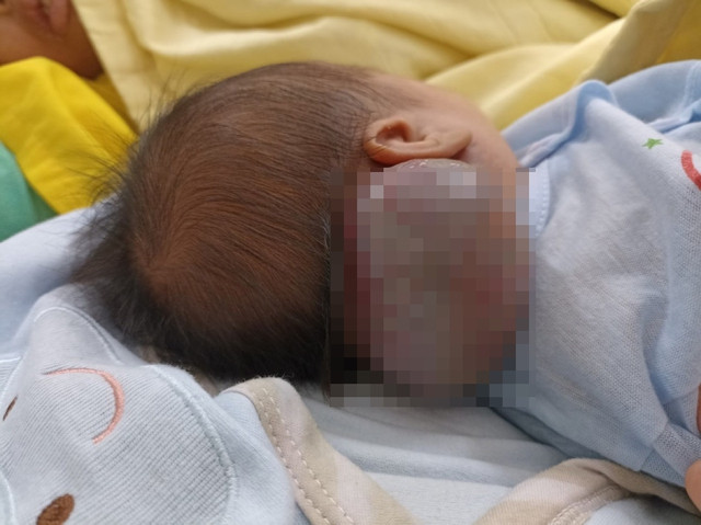 Phẫu thuật khối u máu khổng lồ hiếm gặp ở vùng cổ gáy cho trẻ sơ sinh 14 ngày tuổi