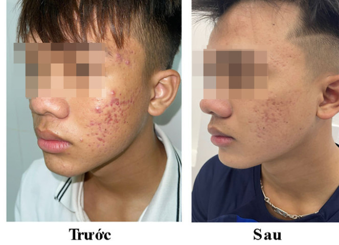 Chuyên gia khuyến cáo các bạn trẻ tuyệt đối: “Không tự ý nặn mụn!”