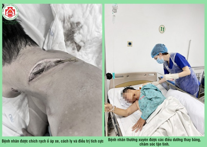 Điều trị cho bệnh nhân bị áp xe vùng cổ gáy trái do mắc bệnh Whitmore