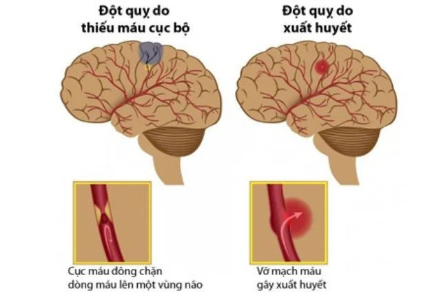 Chuyên gia cảnh báo nguy cơ đột quỵ khi thời tiết trở lạnh
