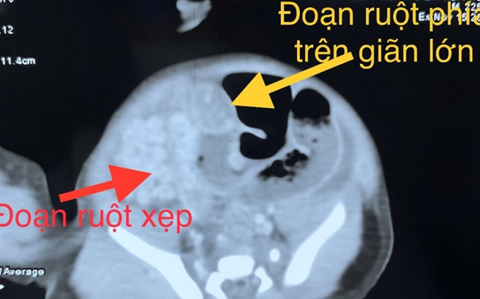 Hải Phòng: Cấp cứu bé sơ sinh bị teo ruột phức tạp