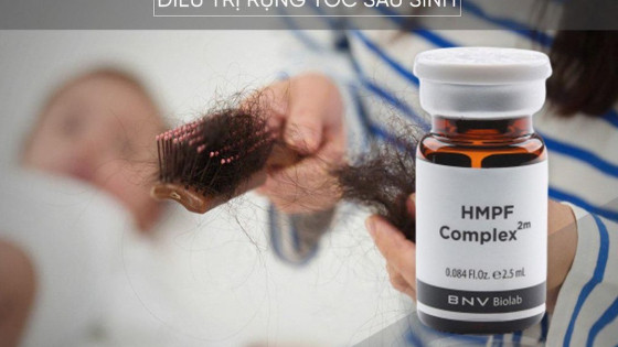 Liệu pháp HMPFComplex2m – Liệu pháp điều trị rụng tóc sau sinh