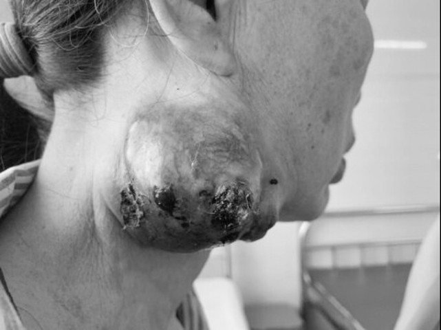 Phẫu thuật và điều trị u tuyến mang tai cho nữ bệnh nhân 68 tuổi