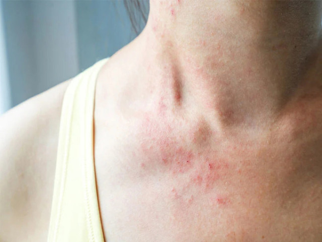 Phương pháp điều trị viêm da cơ địa hiệu quả