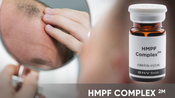 Hói đầu di truyền có chữa được không?