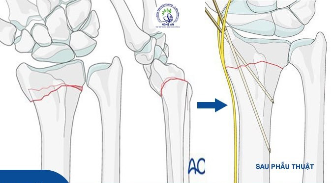 Nghệ An: Phẫu thuật kết hợp xương cho bệnh nhi 9 tuổi bị gãy kín đầu dưới 2 xương cẳng tay