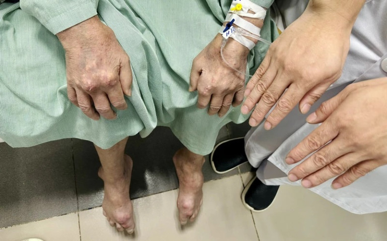 Lạng Sơn: Điều trị cho bệnh nhân 47 tuổi biến chứng gout nặng