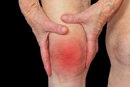 Nhận biết dấu hiệu tràn dịch khớp gối
