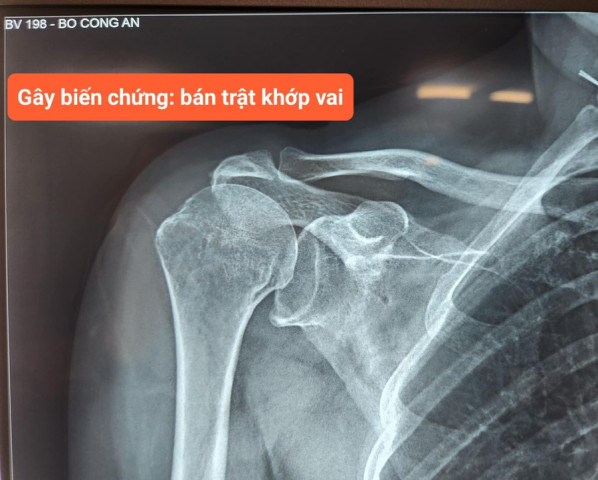 Hà Nội: Phẫu thuật nội soi ghép cân mạc đùi cho bệnh nhân bị đứt gân chóp xoay khớp vai