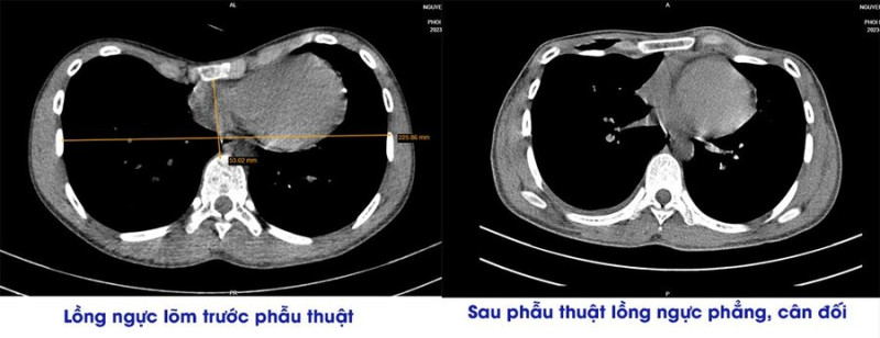 Phú Thọ: Phẫu thuật thành công cho nam bệnh nhân bị lõm ngực suốt 20 năm qua