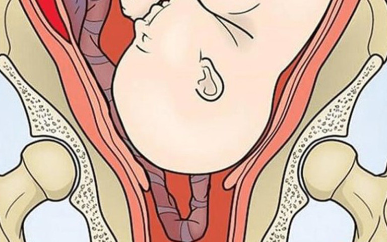 Vĩnh Phúc: Mổ cấp cứu sản phụ bị sa dây rốn cấp, thành công cứu sống bé trai nặng 3,6 kg