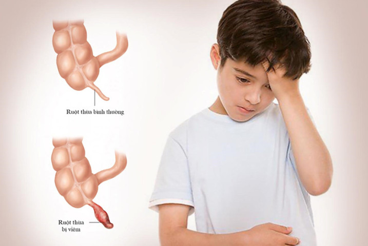 Hải Phòng: Điều trị cho 2 trẻ viêm phúc mạc ổ bụng do viêm ruột thừa vỡ nhập viện muộn
