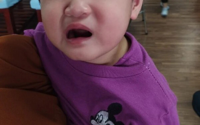 Phú Thọ: Điều trị cho bé 2 tuổi bị liệt dây thần kinh số VII do đi xe máy trong thời tiết lạnh với bố mẹ