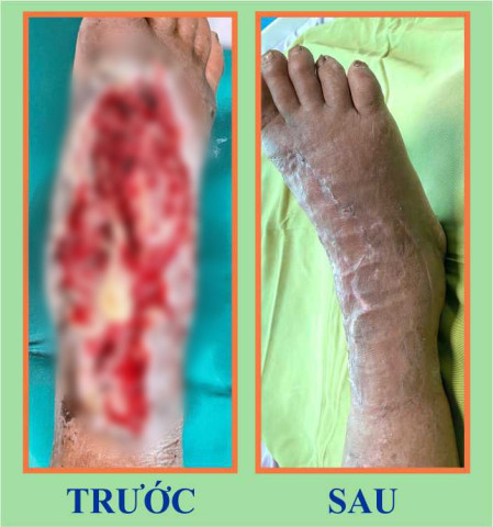 Phú Thọ: Điều trị thành công cho người bệnh bị đa vết thương hở ở chân do tai nạn lao động