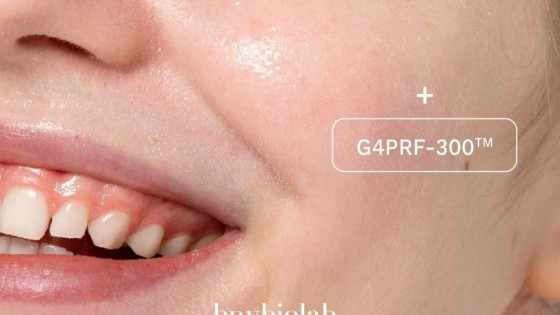 G4PRF-300™ thế hệ nâng cấp exosome