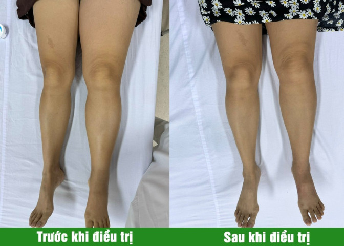 Trị liệu cho bệnh nhân "phù tay voi", "phù chân voi" sau điều trị ung thư