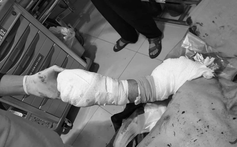 Phú Thọ: Cấp cứu nam bệnh nhân 62 tuổi bị đứt lìa cẳng tay phải do tai nạn lao động