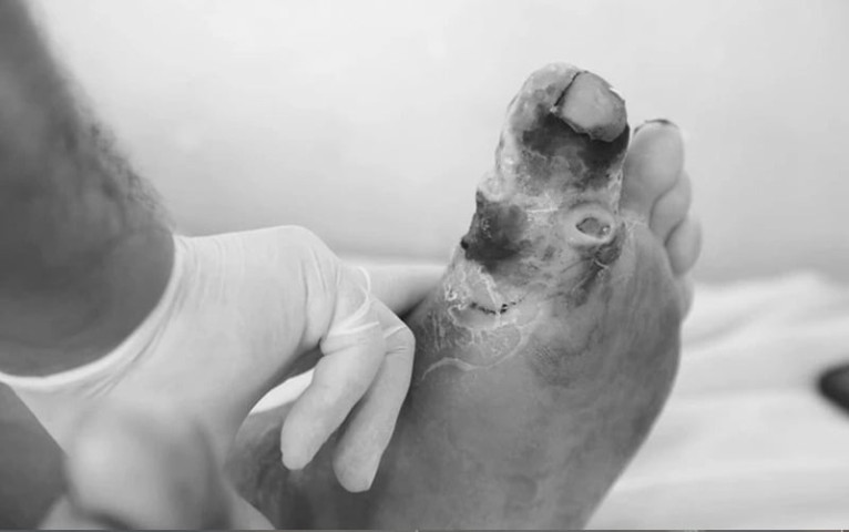 Những biến chứng của bệnh tiểu đường thường gặp nhất