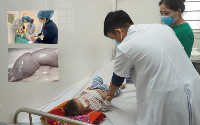 Nghệ An: Gia tăng tình trạng trẻ bị lồng ruột do thời tiết chuyển lạnh