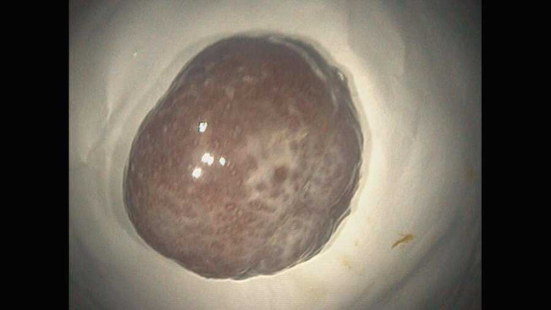 Hải Phòng: Xử trí thành công 2 trường hợp có polyp lớn trong lòng đại tràng gây lồng ruột cho trẻ