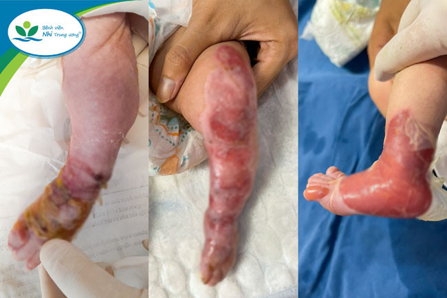 Điều trị cho bé gái 13 ngày tuổi mắc chứng bệnh ly thượng bì bọng nước bẩm sinh