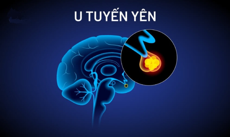 Nghệ An: Bé trai 7 tuổi đau đầu, thị lực kém vào viện thăm khám phát hiện u tuyến yên