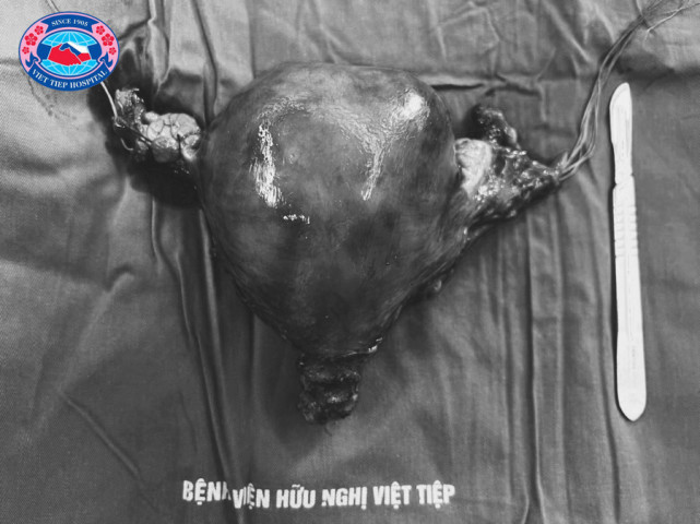 Hải Phòng: Phẫu thuật thành công cho bệnh nhân có khối u nội mạc tử cung với kích thước 20 cm