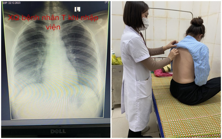 Nghệ An: Điều trị cho nữ bệnh nhân 29 tuổi bị viêm thùy phổi