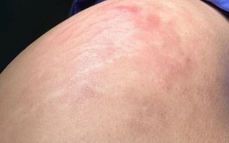 Cô gái bị áp-xe mông sau khi tiêm filler 4 năm trước