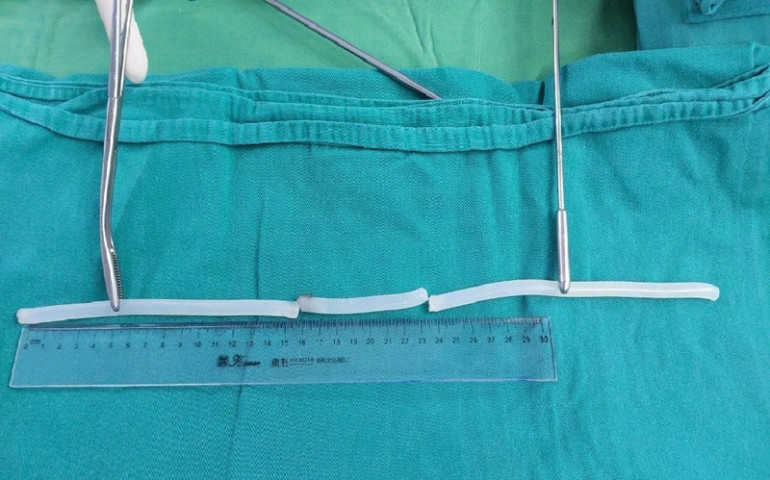 Hà Nội: Xử trí một bệnh nhân tự nhét một cây keo nến dài 40 cm vào niệu đạo, bàng quang