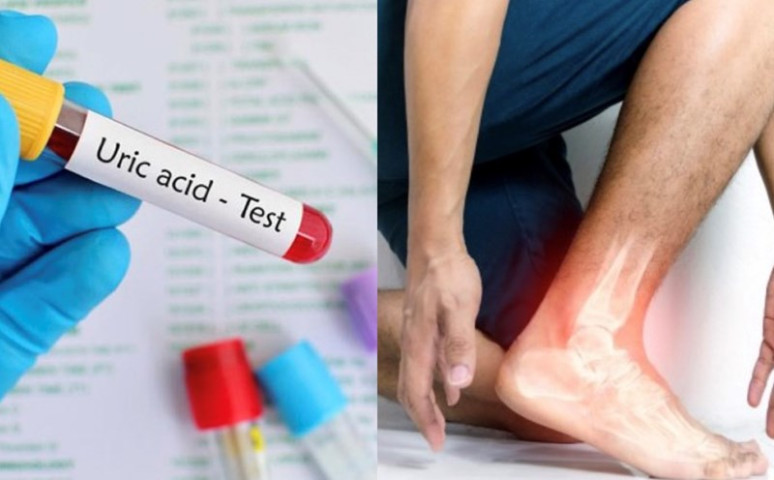 Cách giúp thận không bị tổn thương khi axit uric tăng cao