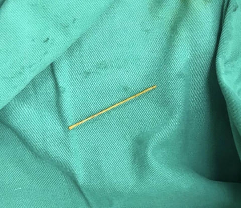 Thanh Hóa: Bệnh nhân thủng tá tràng do nuốt phải tăm tre dài 5 cm
