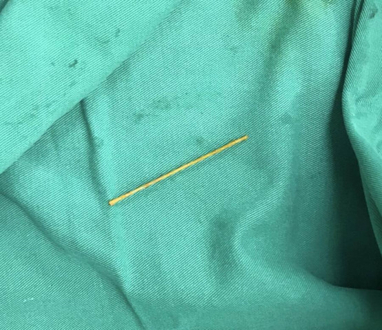 Thanh Hóa: Bệnh nhân thủng tá tràng do nuốt phải tăm tre dài 5 cm