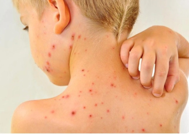 Những bài thuốc điều trị bệnh cho trẻ em (phần 3)