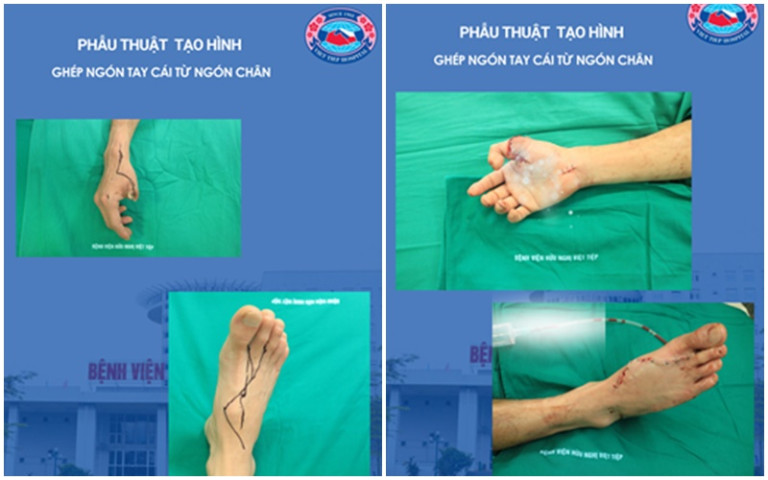 Hải Phòng: Tạo hình vi phẫu chuyển ngón chân lên tay tái tạo ngón tay cho bệnh nhân bị tai nạn lao động