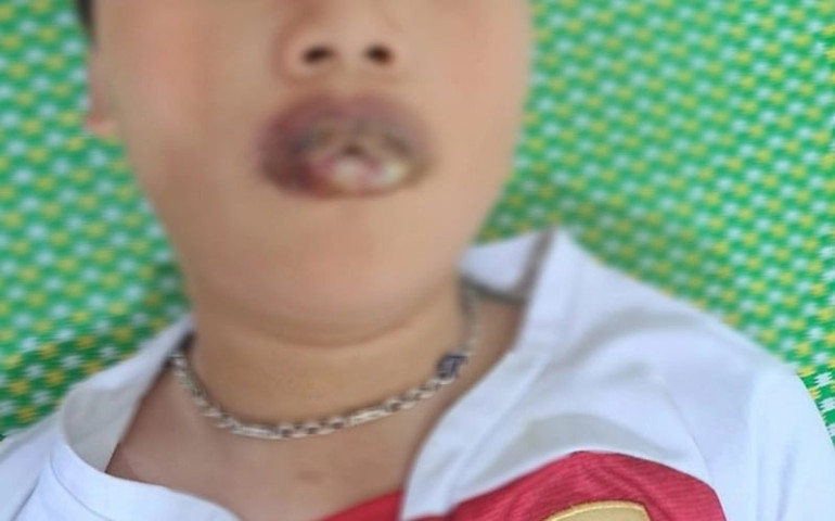 Hải Phòng: Bé 11 tuổi nhập viện điều trị do gia đình tự ý mua thuốc để điều trị bệnh ho, sốt