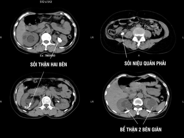 Phú Thọ: Phẫu thuật sỏi niệu quản và sỏi thận 2 bên cùng lúc cho 1 bệnh nhân 49 tuổi
