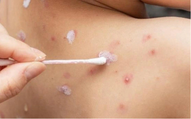 Nghệ An thành công cứu sống bé gái bị thuỷ đậu nguy kịch
