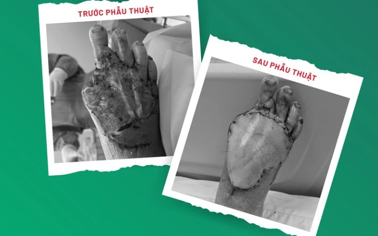 TP. Hồ Chí Minh: Chuyển vạt da vi phẫu cứu bệnh nhân bị mất da toàn bộ mu bàn chân
